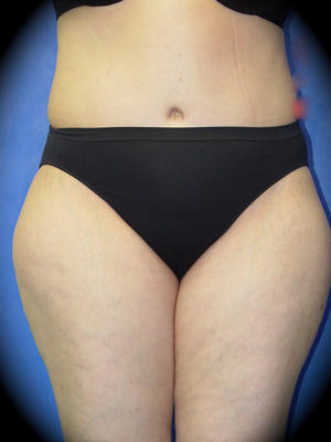 After Abdominoplasty Los Angeles