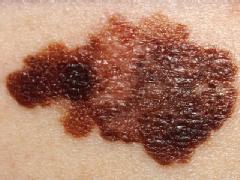 melanoma drug