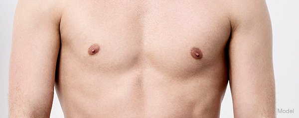 gynecomastia