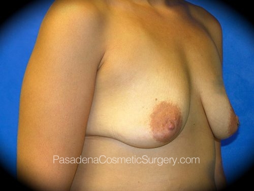 Breast Augmentation Patient 01 Before - 2