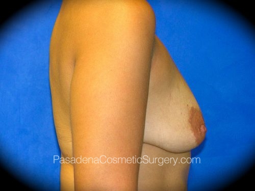 Breast Augmentation Patient 01 Before - 3