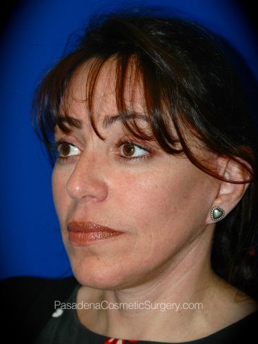 Facelift Patient 01 After - 2