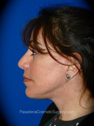 Facelift Patient 01 After - 3