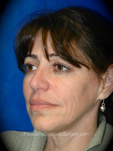 Facelift Patient 01 Before - 2