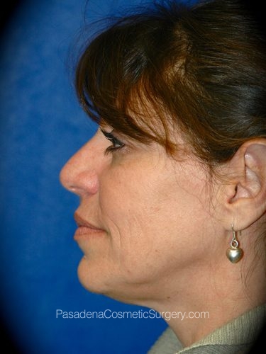 Facelift Patient 01 Before - 3