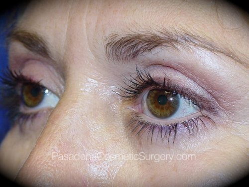 Eyelid Surgery Patient 12 After - 2