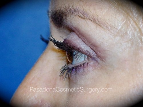 Eyelid Surgery Patient 12 After - 3