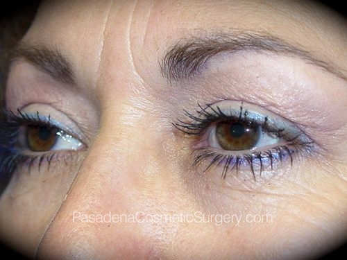 Eyelid Surgery Patient 12 Before - 2
