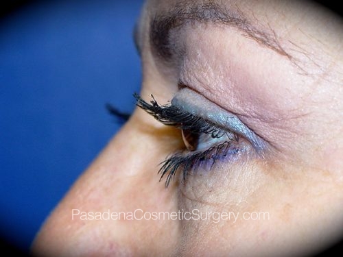 Eyelid Surgery Patient 12 Before - 3