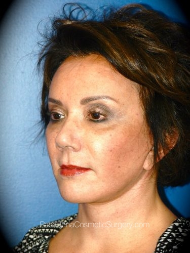 Facelift Patient 07 After - 2