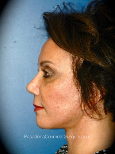 Facelift Patient 07 After - 3