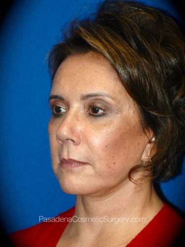 Facelift Patient 07 Before - 2