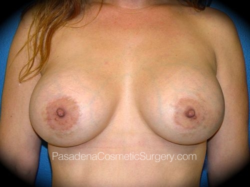 Breast Augmentation Patient 14 After
