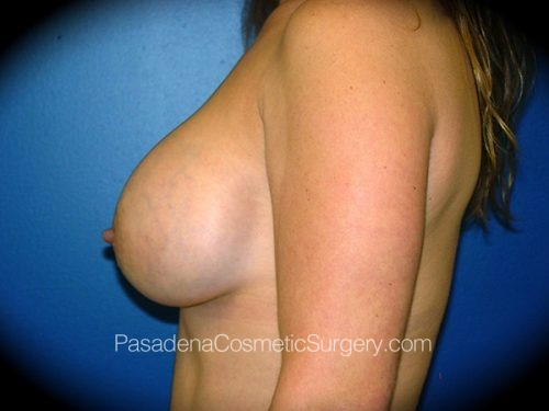 Breast Augmentation Patient 14 After - 3