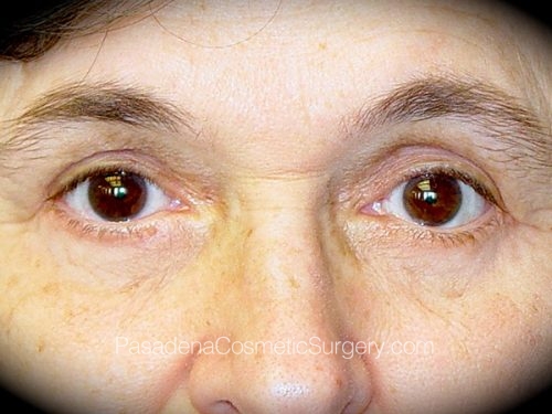 Eyelid Surgery Patient 13 After