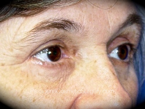 Eyelid Surgery Patient 13 After - 2