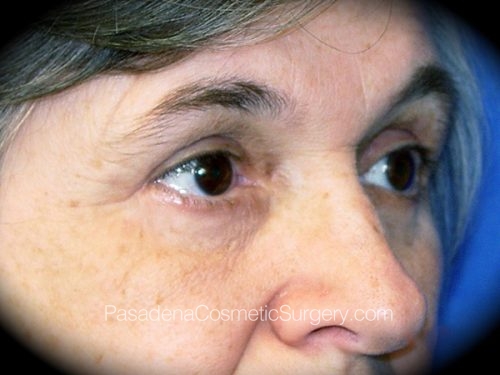 Brow Lift Patient 04 After - 2