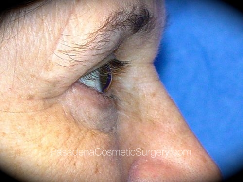 Eyelid Surgery Patient 13 After - 3