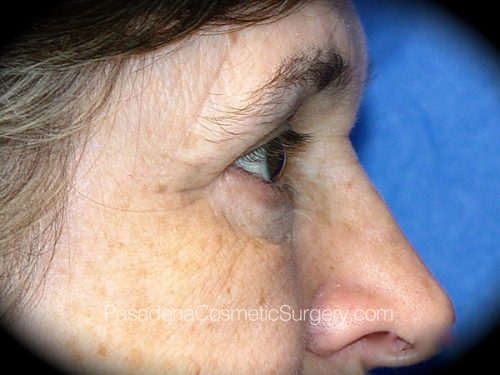 Brow Lift Patient 04 After - 3