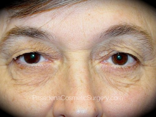 Eyelid Surgery Patient 13 Before