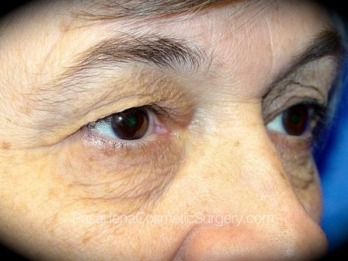 Eyelid Surgery Patient 13 Before - 2