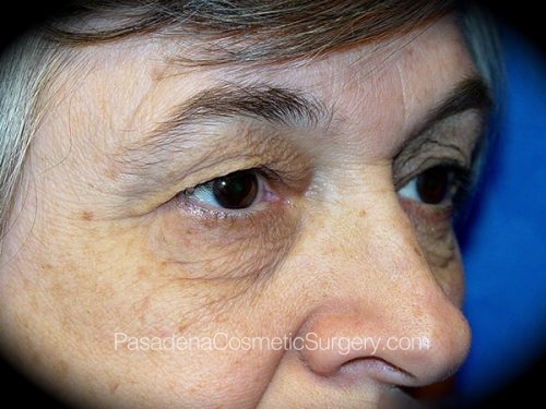 Brow Lift Patient 04 Before - 2