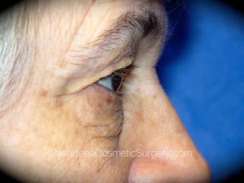 Eyelid Surgery Patient 13 Before - 3