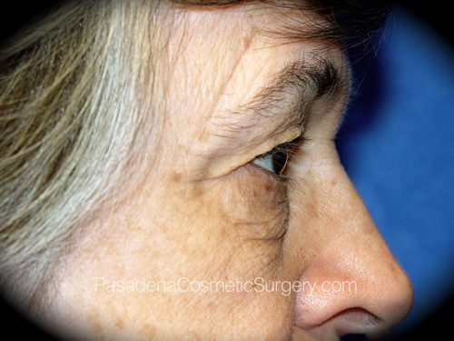 Brow Lift Patient 04 Before - 3