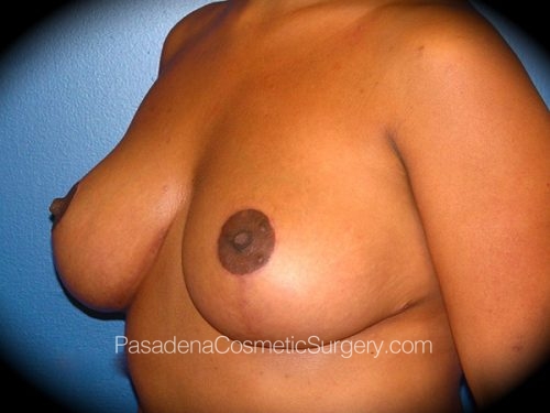 Breast Lift Patient 04 After - 2