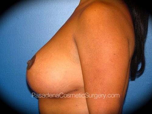 Breast Lift Patient 04 After - 3