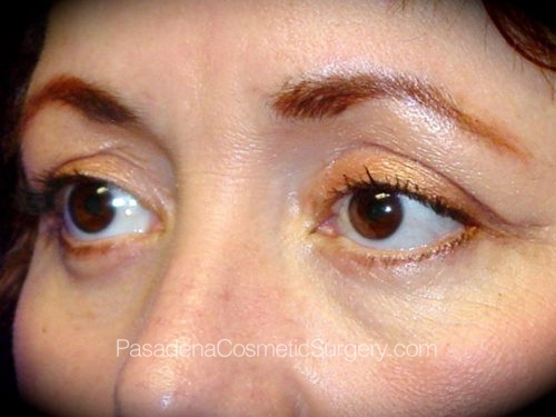 Eyelid Surgery Patient 14 After - 2