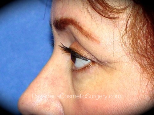 Eyelid Surgery Patient 14 After - 3