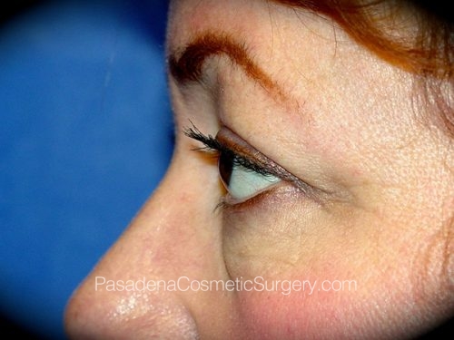 Eyelid Surgery Patient 14 Before - 3