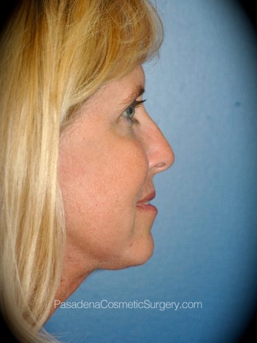 Facelift Patient 08 After - 2