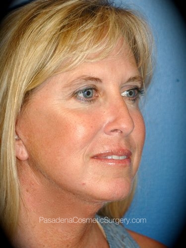 Laser Skin Resurfacing Patient 02 After - 2