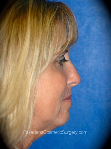 Laser Skin Resurfacing Patient 02 Before - 3