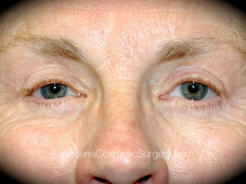 Eyelid Surgery Patient 15 After