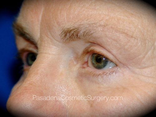 Eyelid Surgery Patient 15 After - 2