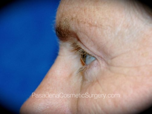 Eyelid Surgery Patient 15 After - 3
