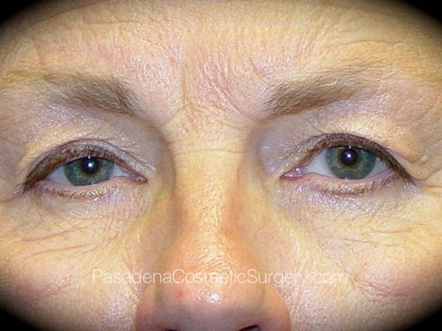 Eyelid Surgery Patient 15 Before