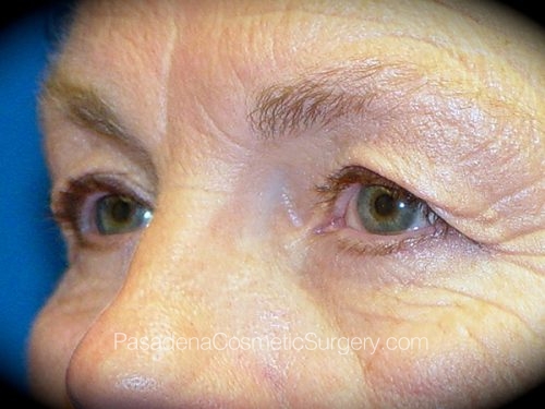 Eyelid Surgery Patient 15 Before - 2