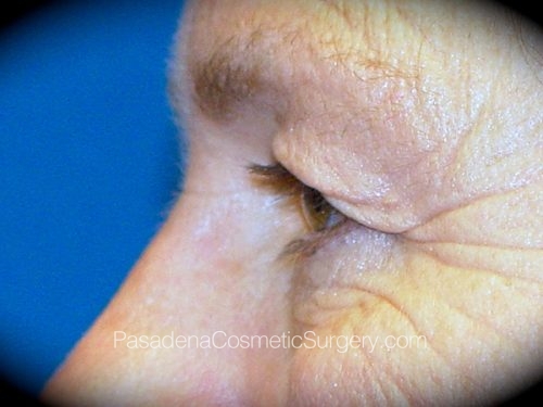 Eyelid Surgery Patient 15 Before - 3