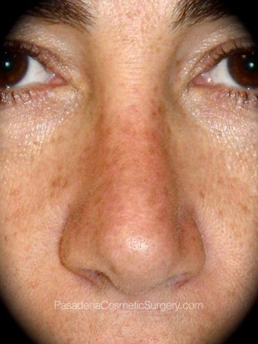 Rhinoplasty Patient 04 After