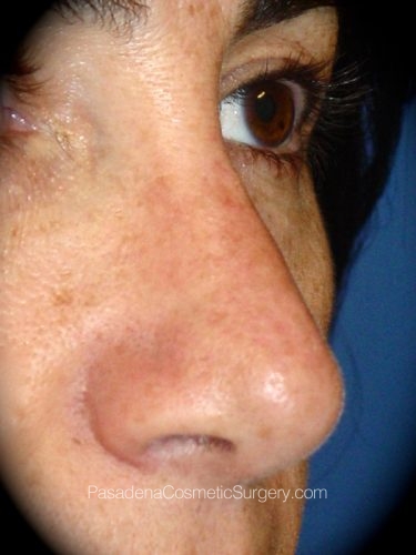 Rhinoplasty Patient 04 After - 2