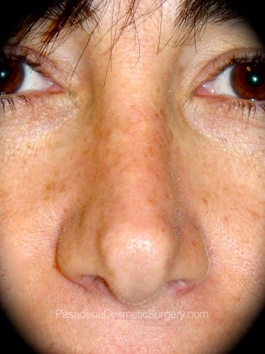 Rhinoplasty Patient 04 Before
