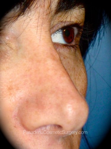 Rhinoplasty Patient 04 Before - 2