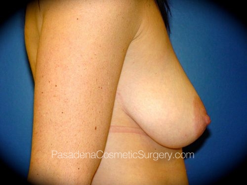 Breast Augmentation Patient 16 Before - 3