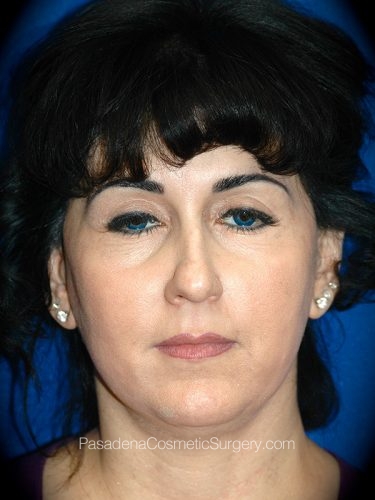 Facelift Patient 09 Before
