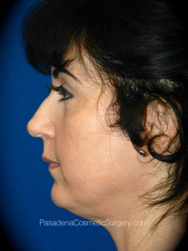 Facelift Patient 09 Before - 2