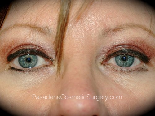 Eyelid Surgery Patient 16 After
